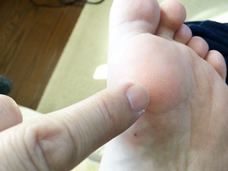 足の指の付け根が痛い( ;∀;) ※種子骨炎の原因と対処方法とは